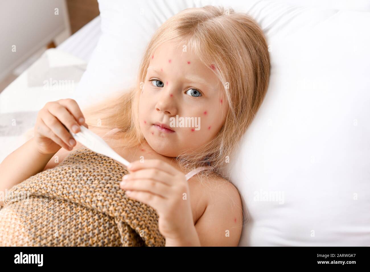 Bambina malata con la varicella a letto Foto stock - Alamy