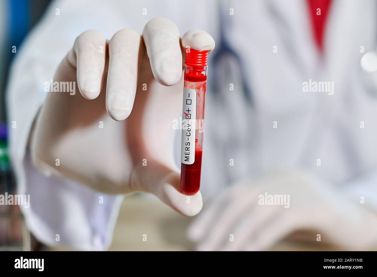Provetta per analisi del sangue in una mano di medico, Mers-COV Coronavirus test Etichetta Positiva nella provetta per analisi del sangue dell'ospedale. 2019-ninfezione da virus CoV Foto Stock