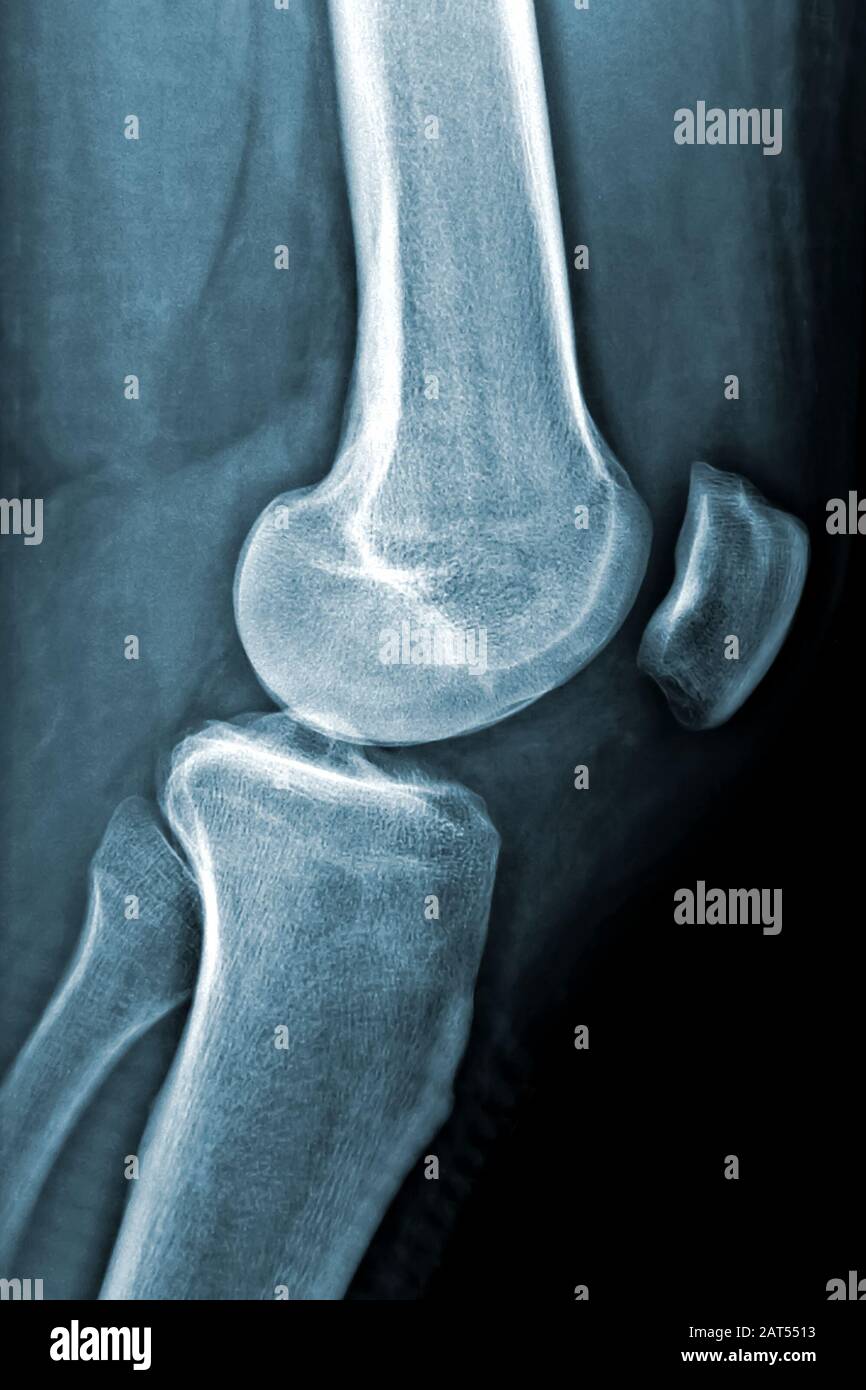 Radiografia del ginocchio sinistro maschio o immagine verticale a raggi X. Immagini mediche e sanitarie. Foto Stock