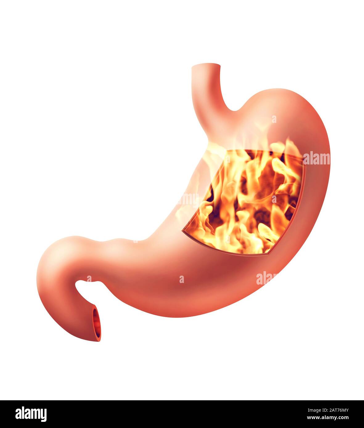 Illustrazione fotorealistica dello stomaco umano con malattia da bruciore di stomaco Foto Stock