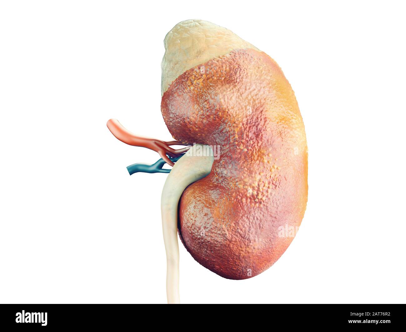 Fotorealistico 3d illustrazione di rene umano malattia cancro con la ghiandola surrenale e navi isolato su bianco Foto Stock