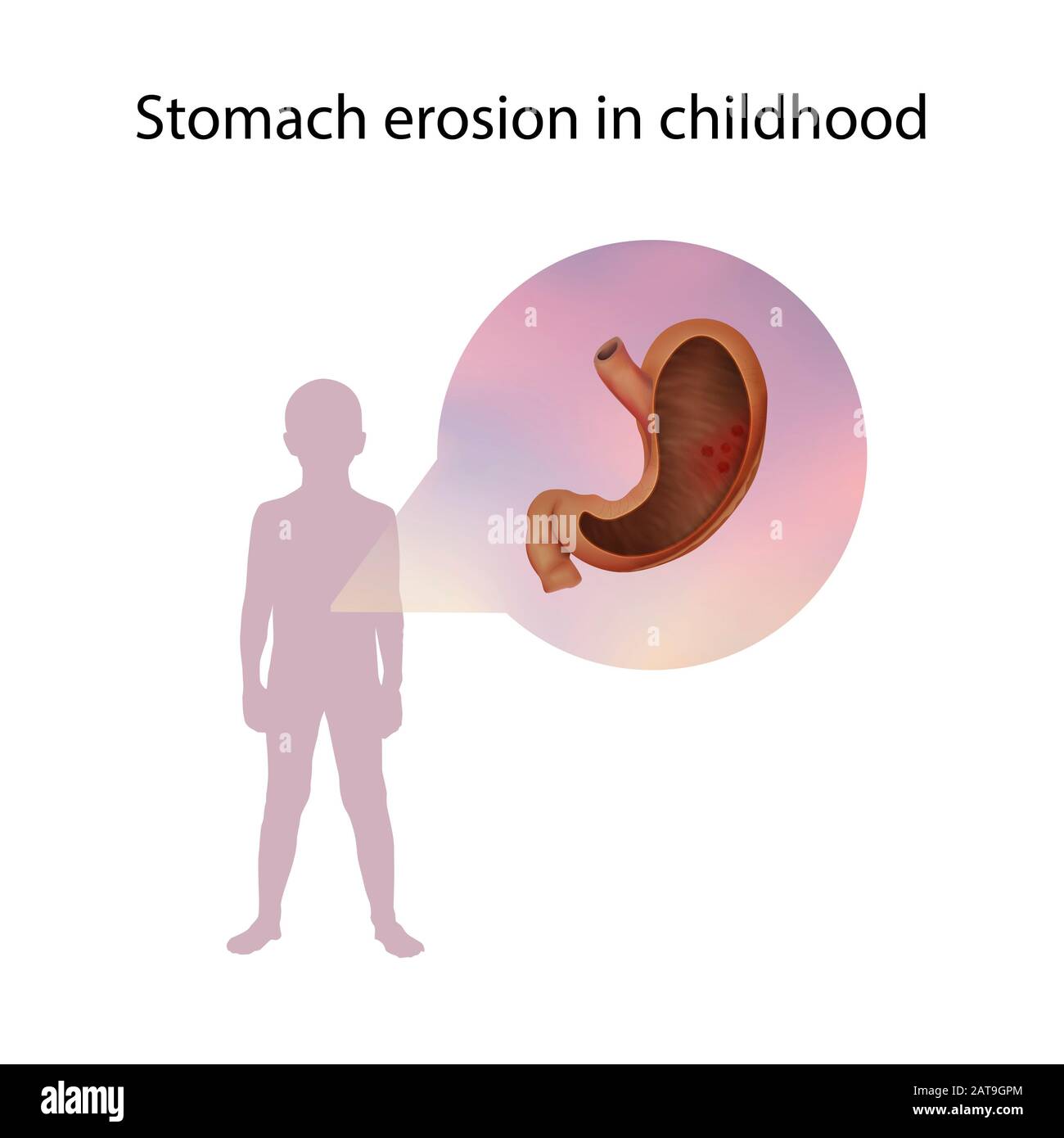 Erosione di stomaco nell'infanzia, illustrazione Foto Stock