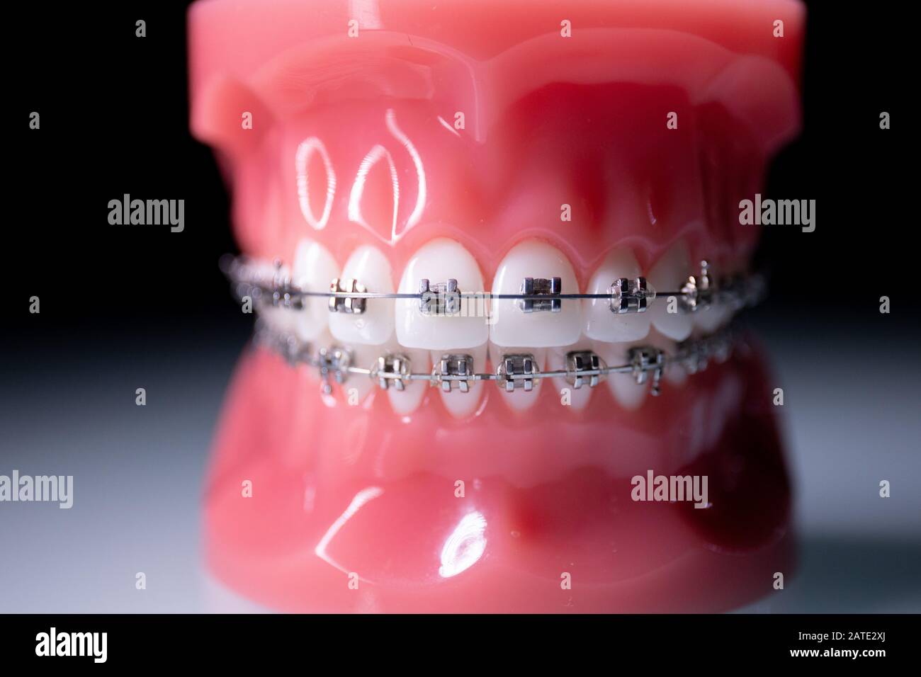 Primo piano dei denti con bretelle metalliche. La ganascia con parentesi  graffe ruota sulla superficie Foto stock - Alamy