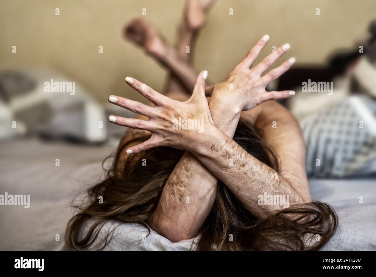 Armi incrociate di una donna con Tagli pesanti e cicatrici di auto-mutilazione in frustrazione, auto-abusando, Borderline personalità disordine. Foto Stock