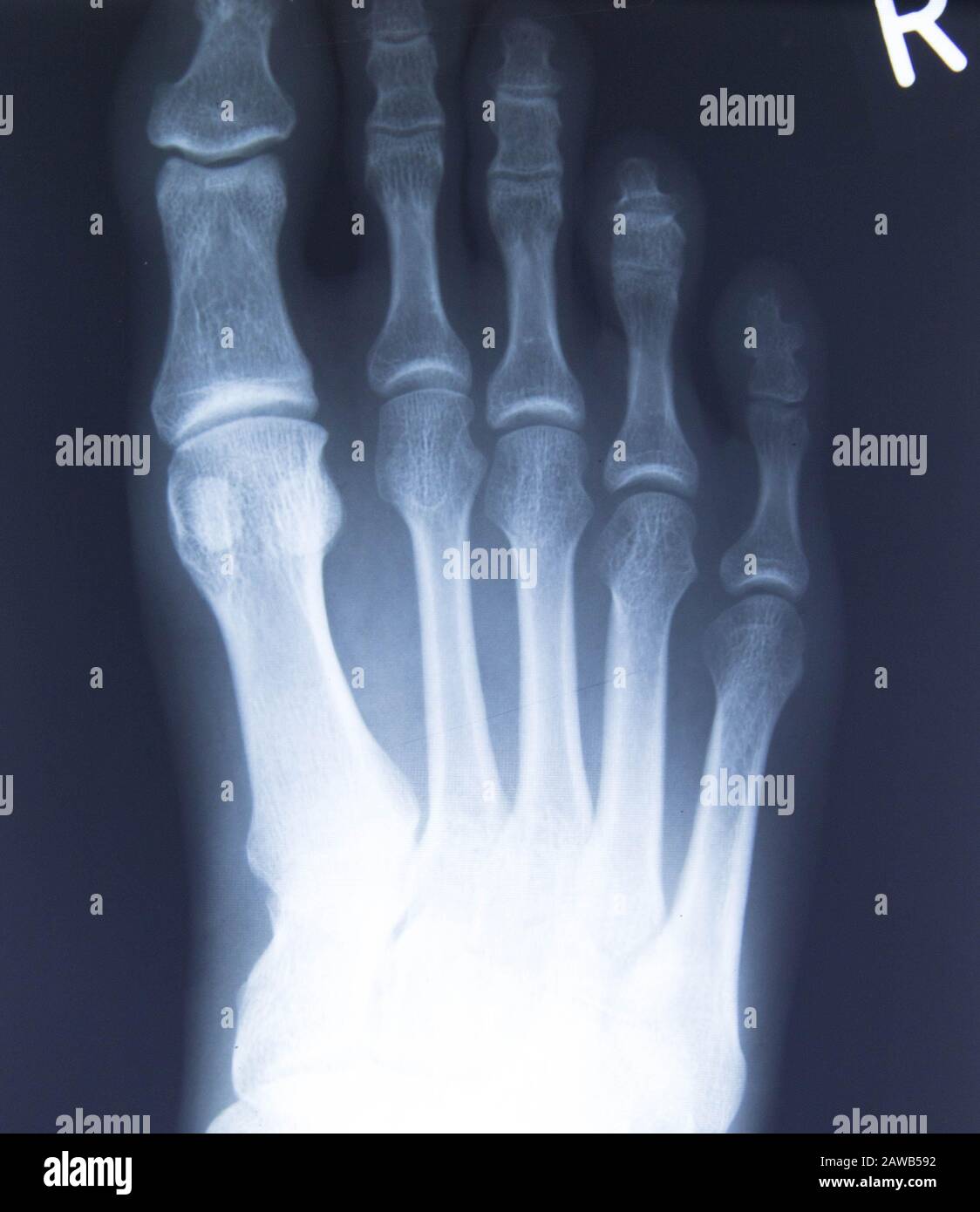 Radiografia normale del piede, diagnostica medica, Traumatologia ed ortopedia, reumatologia Foto Stock
