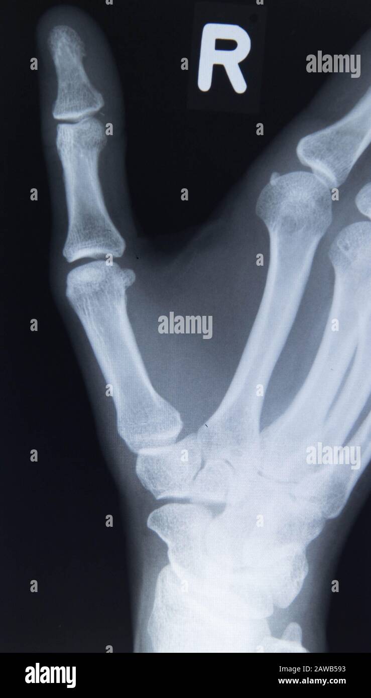Raggi X di mano con artrite su sfondo nero Foto Stock