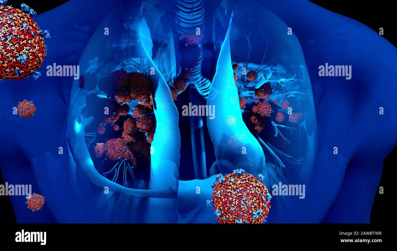 Infezione polmonare da coronavirus, illustrazione concettuale Foto Stock