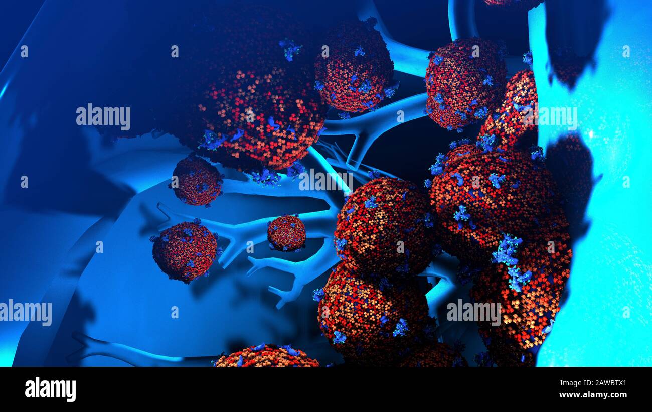 Infezione polmonare da coronavirus, illustrazione concettuale Foto Stock