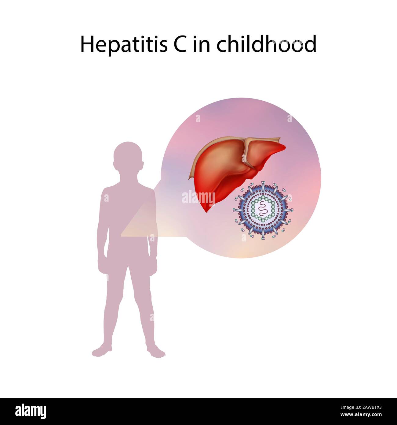 Epatite C nell'infanzia, illustrazione Foto Stock