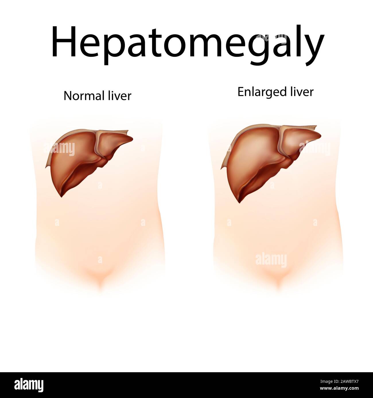 Epatomegalia, illustrazione Foto Stock
