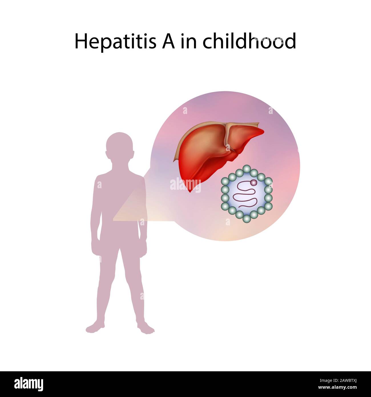 Epatite A nell'infanzia, illustrazione Foto Stock