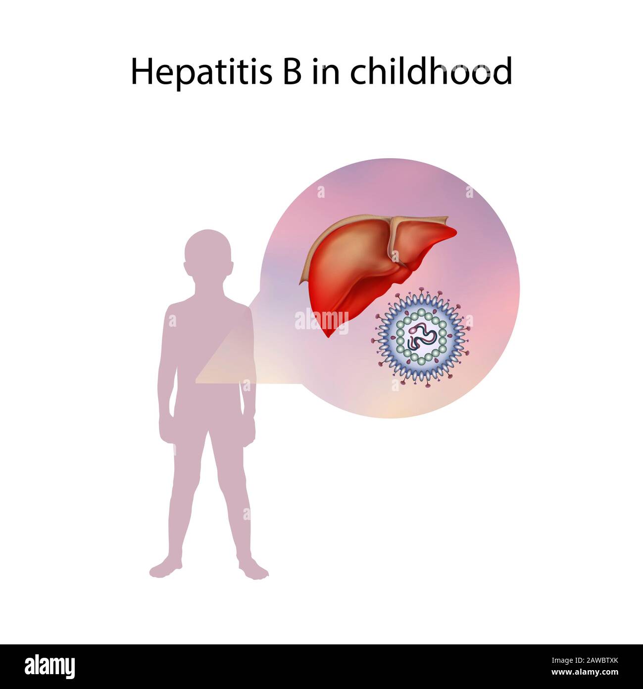 Epatite B nell'infanzia, illustrazione Foto Stock