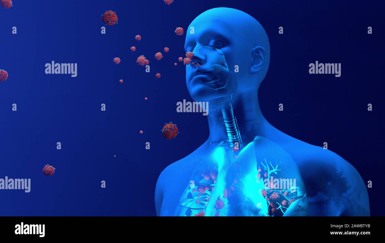 Infezione polmonare da coronavirus, illustrazione concettuale Foto Stock