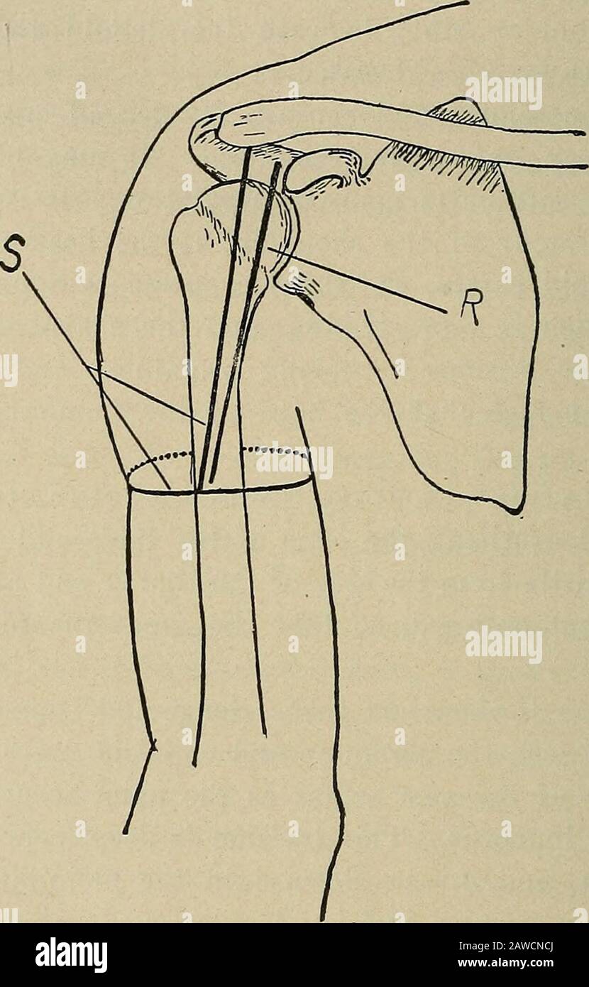 Chirurgia operativa, per studenti e praticanti . sion, sull'aspetto interno del braccio, dovrebbe passare solo attraverso l'integru-ment e fascia superficiale (grasso sottocutaneo), cura essendo takennot per cucire i vasi brachiali; per il resto della circonferenza del braccio, tuttavia, questa incisione circolare penetra attraverso tutte le parti morbide fino all'osso. Il bordo esterno della ferita viene grippato, e con un bisturi le parti morbide vengono allontanate dalla superficie esterna dell'omero, il braccio essendo ruotato verso l'interno dall'assistente, per facilitare questa fase dell'operazione. Il legamento capsulare essendo NO Foto Stock
