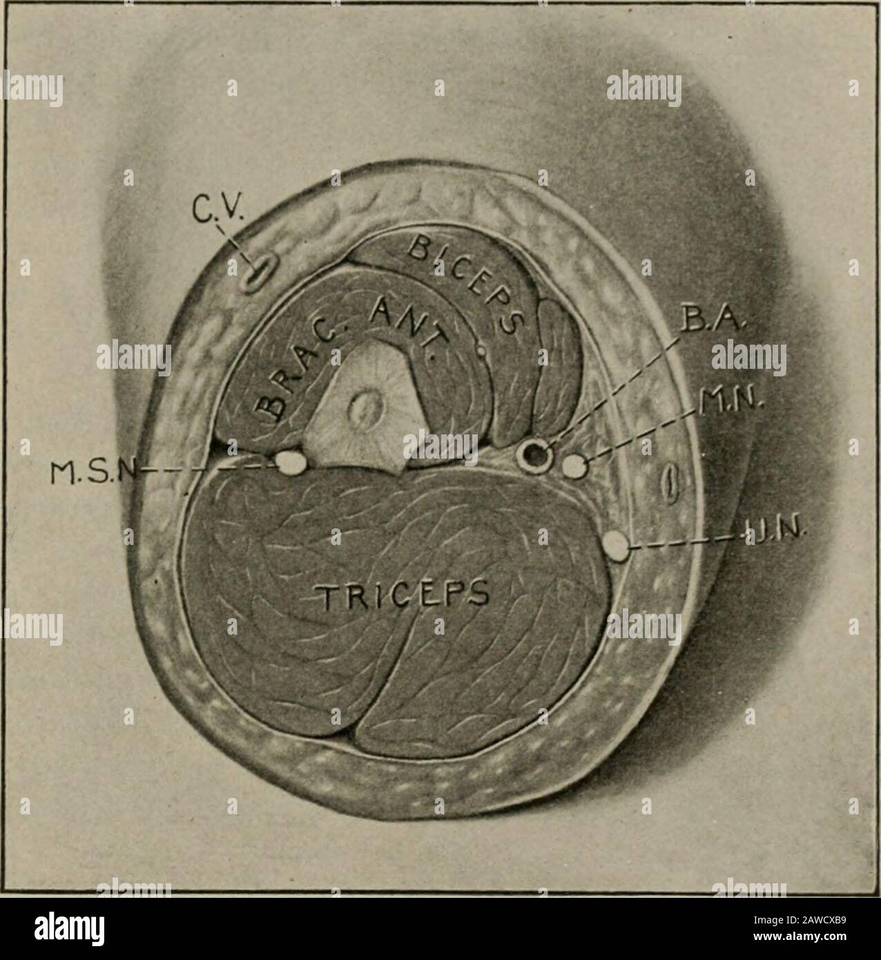 Chirurgia operativa, per studenti e praticanti. Dalla fascia profonda, ma circa la metà del braccio pierces la fascia profonda, e così entra in più stretta relazione con l'arteria. Nella parte superiore del braccio la basilica unisce le venge comites per formare la vena ascellare. Lungo il lato esterno del braccio, superficiale alla fascia profonda, corre la vena cefalica; sopra questa vena si trova nella scanalatura tra il maggiore del pettorale e il deltoide, e, dopo aver perforato la membrana costo-coracoide, passa attraverso la prima parte dell'arterioto ascellare vuoto nella vena ascellare. Al gomito, sul Foto Stock