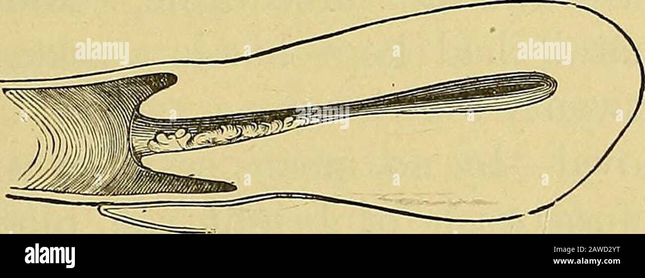 Note cliniche sulla chirurgia uterina : con particolare riferimento alla gestione della condizione sterile . Fig. 16. rappresenterebbe il profilo generale e la relativeposizione dell'utero prima che la tenda di spugna fosse usata; mentre la fig. 17 mostrerebbe una sezione verticale dell'organo. Fig. IV. Dopo la sua rimozione, quando potevo vedere facilmente le verdure sulla superficie posteriore del canale cervicale, come mostrato nel diagramma. Questi avrebbero potuto essere raschiedaway con Recamiers curette; ma ero ansioso aprire il canale più in gran parte e più in alto, nella cavità dell'utero, con una vista di più facilmente applicare Foto Stock