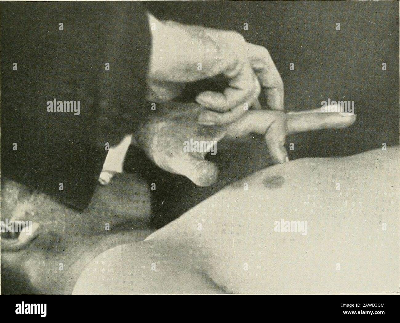 Malattie del torace e i principi della diagnosi fisica . t si angolano al suo collega, e in direzione verticale sul petto (ortopercussioni). Se ciò è impossibile, può essere sostituito un moncone di piombo. In altre parole, il pleximetro non è solo piccolo butverticalmente posizionato. Il colpo colpito dal plesso è così leggero che i tessuti onlyrisonanti producono qualsiasi suono udibile; quando i tessuti opachi hanno colpito la loro nota è al di sotto della nostra soglia uditiva (Fig. 80). Metodi E RISULTATI DELLA PERCUSSIONE 91 , il Coin Test.- - Nell'esecuzione di questo test vengono utilizzate monete d'argento, come il theplexor e il pleximeter rispetto Foto Stock