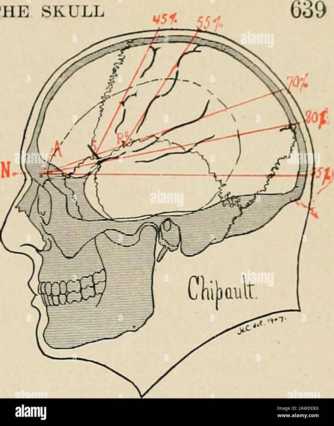 La pratica della chirurgia . Fig. 417. NO = linea equatore-iale Kochres, nision to inion. XL = PoiriersSylvian linea dalla nisione alla lambda.ma = Kochres meridiandrawn anteriore 60° dalla linea meridiana al punto medio sag-ittale; si trova sopra convolu-zione precentrale e attraversa XL al punto Sylvian,Sfs = solco frontale superiore ad un terzo della ma; Sfi = sul-cus frontale inferiore a due terzi della ma. MP = Kochres meridiano posteriore, anche a 60°dalla linea mediana. Linee che attraversano a Sts = superiore solco temporale (chirurgia di inKeens Gushing).. Fig. 45-5 per cento, linea naso-inionica mediana = punto prero-landico; 55 per c Foto Stock