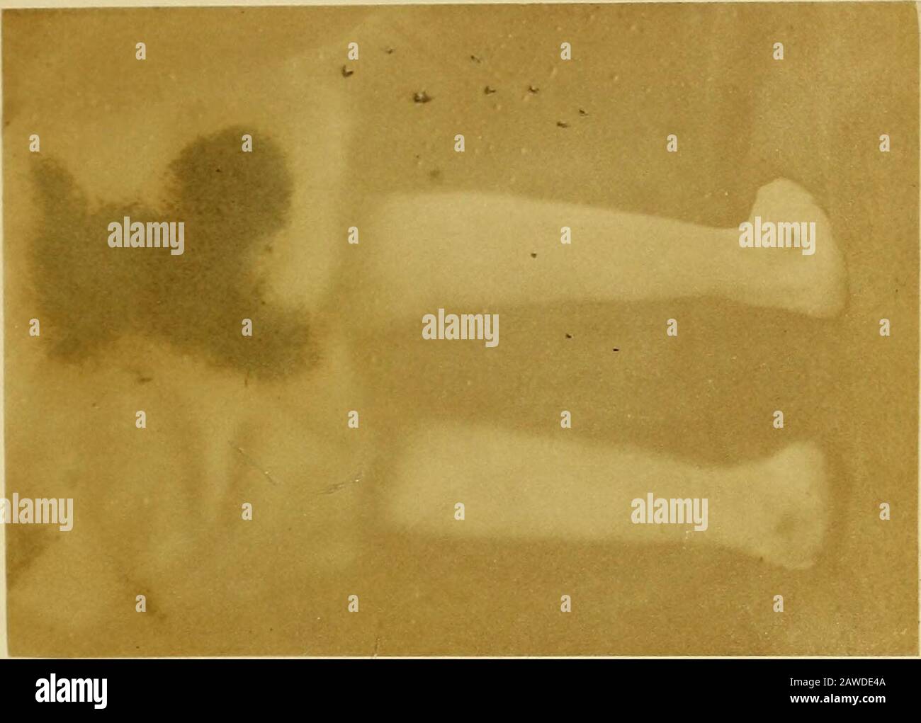 Sulla cura del piede-randello senza tagliare tendini : e su certi nuovi metodi di trattamento di altre deformità . ora molto meglio sul terreno che T credeva opportuno fornire il peroneo longus e brevis. 7th Giugno. - la fotografia (Piastra xxi.) mostra la posizione a questa data. 1st luglio.^la posizione dei piedi, soprattutto di altezza, molto migliorata, la postura, quando le molle sono fissate, più quasi naturale. 28th luglio. - il POM^er nelle gambe e nei piedi aumenta-eatly, la fotografia (Piastra xxii.) mostra il miglioramento in postura. C'è solo un graduale miglioramento da segnalare; theboy Foto Stock