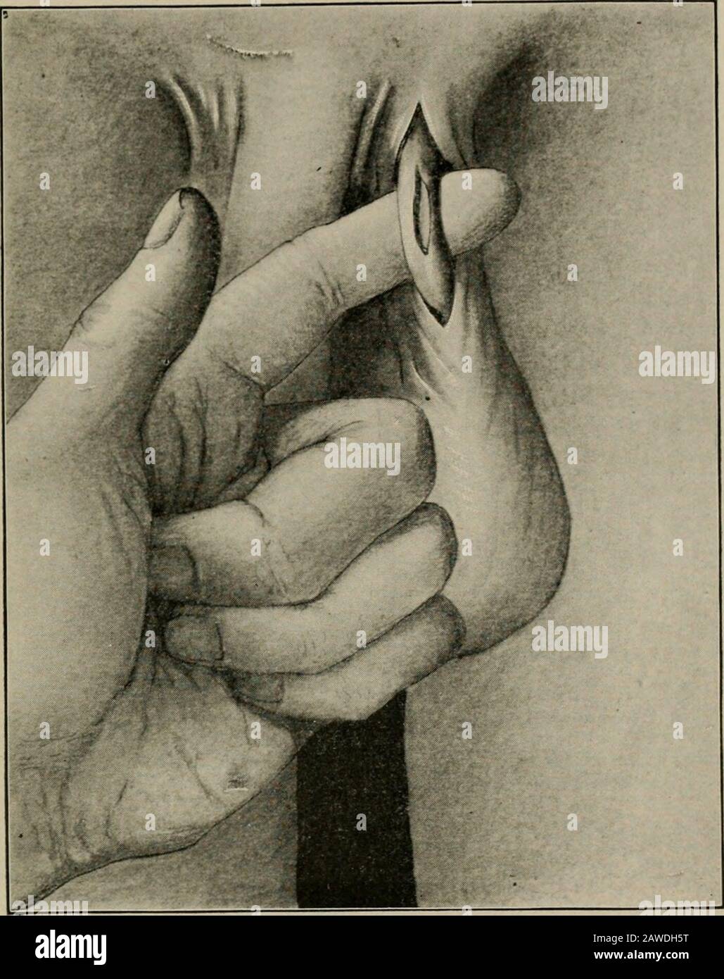 Varicocele Immagini E Fotos Stock Alamy