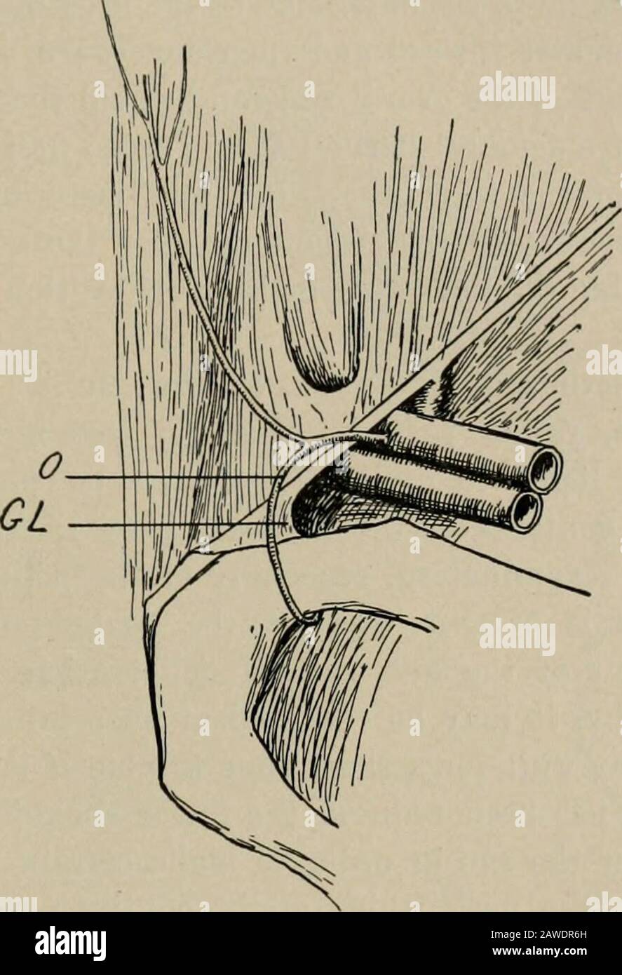 Chirurgia operativa, per studenti e praticanti . variare; possono essere costituiti da intestino, grande o piccolo; di omentum, o di entrambi; e occasionalmente ci possono essere altri organi, come la vescica, ovaio, ecc. Dopo che il sacco è stato freelyopened, il suo contenuto dovrebbe essere esaminato. Qualsiasi fascia di costrizione nel corpo del sacco deve essere divisa, e un tentativo quindi fatto rovesciare l'intestino in basso in modo da facilitare esso al punto di costrizione; butin questo sforzo molta forza non dovrebbe essere usata. Uno sforzo è fatto a OPERAZIONI PER ERNIA. 617 inserire il dito nel collo del sacco, e, se questo è successo, un Foto Stock