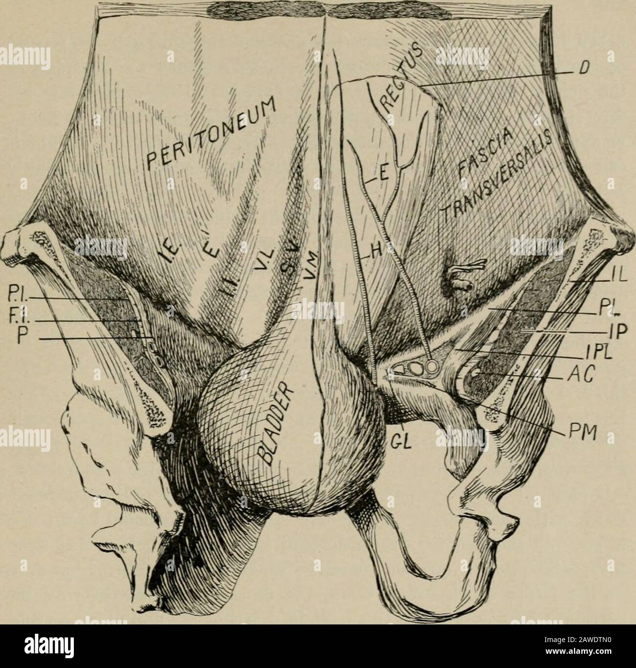 Intervento chirurgico operativo, per studenti e praticanti. Si verifica questa parte della parete posteriore del canale inguinale, e l'ernialsac, composto dal peritoneo parietale, avrà come rivestimenti, dall'interno verso l'esterno, i vari strati che formano questa parte della parete posteriore del canale inguinale, vale a dire, la fascia transsalis, il tendine congiunto, e il legamento triangolare, e, inoltre, il profondo la3^er della fascia superficiale (fascia spermatica), lo strato superfiale della fascia superficiale (grasso), e la pelle. Il collo della sacca in un'ernia inguinale diretta si trova sul lato interno di Foto Stock