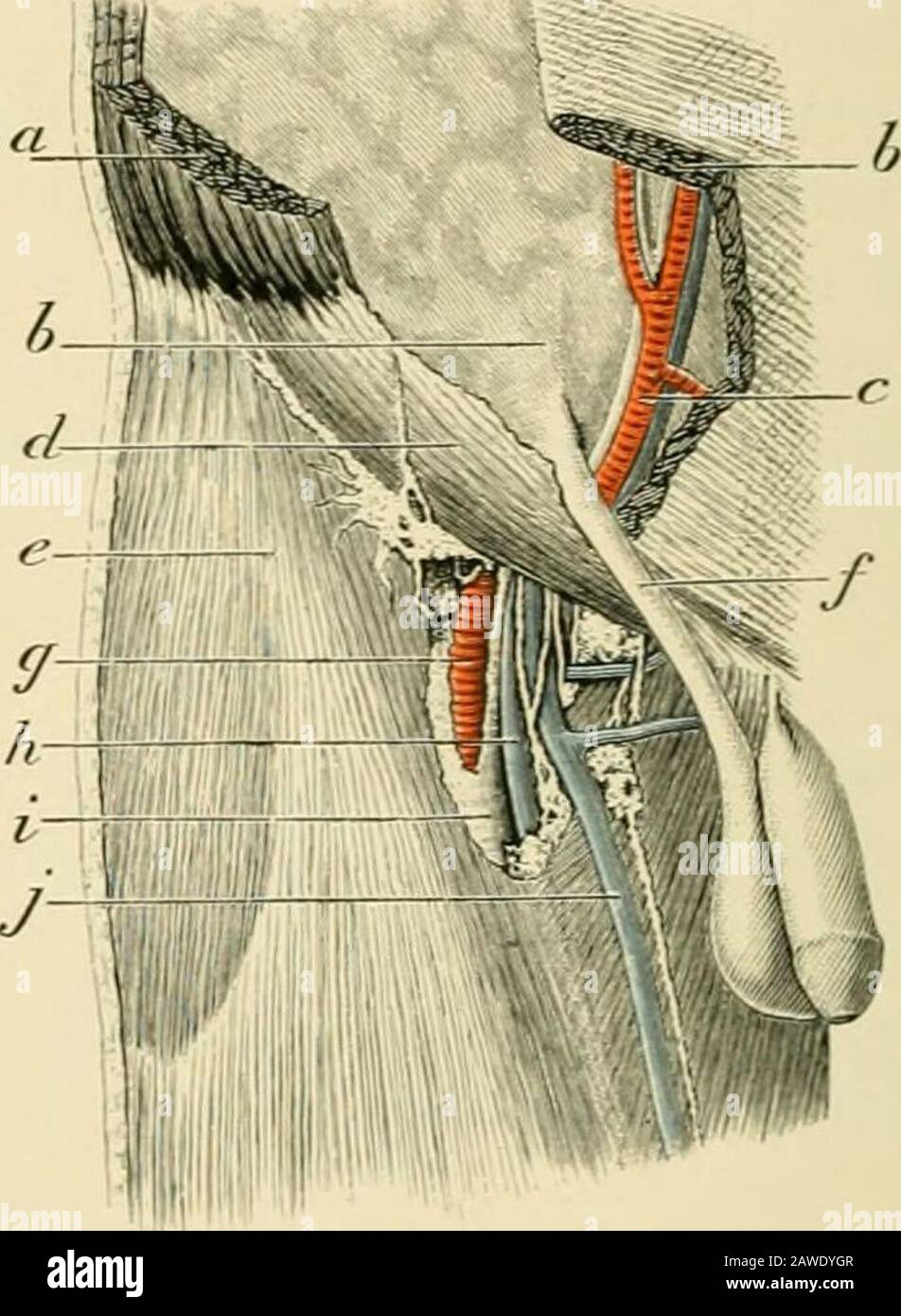 Chirurgia operativa . Fig. 1113. Fig. 1114. Fig. 1113.-ernia inguinale indiretta o obliqua, contenuto intestinale e omentale, a, a.. Integrativo e fascia superficiale, h.. Aponeurosi del muscolo obliquo esterno, c. Fascia transversalis. D. SAC di ernia, p. Omentum. /. Intestino.Fig. 1114.-l'anatomia delle regioni inguinali e femorali, che mostra il corso di discesa dell'ernia inguinale indiretta o obliqua, o. Bordi divisi dei muscoli addominali, b. Tranversalis fascia, c. Vasi epigastrici profondi, d.. Aponeurosi del muscolo obliquo esterno, ad es Fascia lata. /. Cordone spermatico G.. Arteria femorale, h. Ve femorale Foto Stock