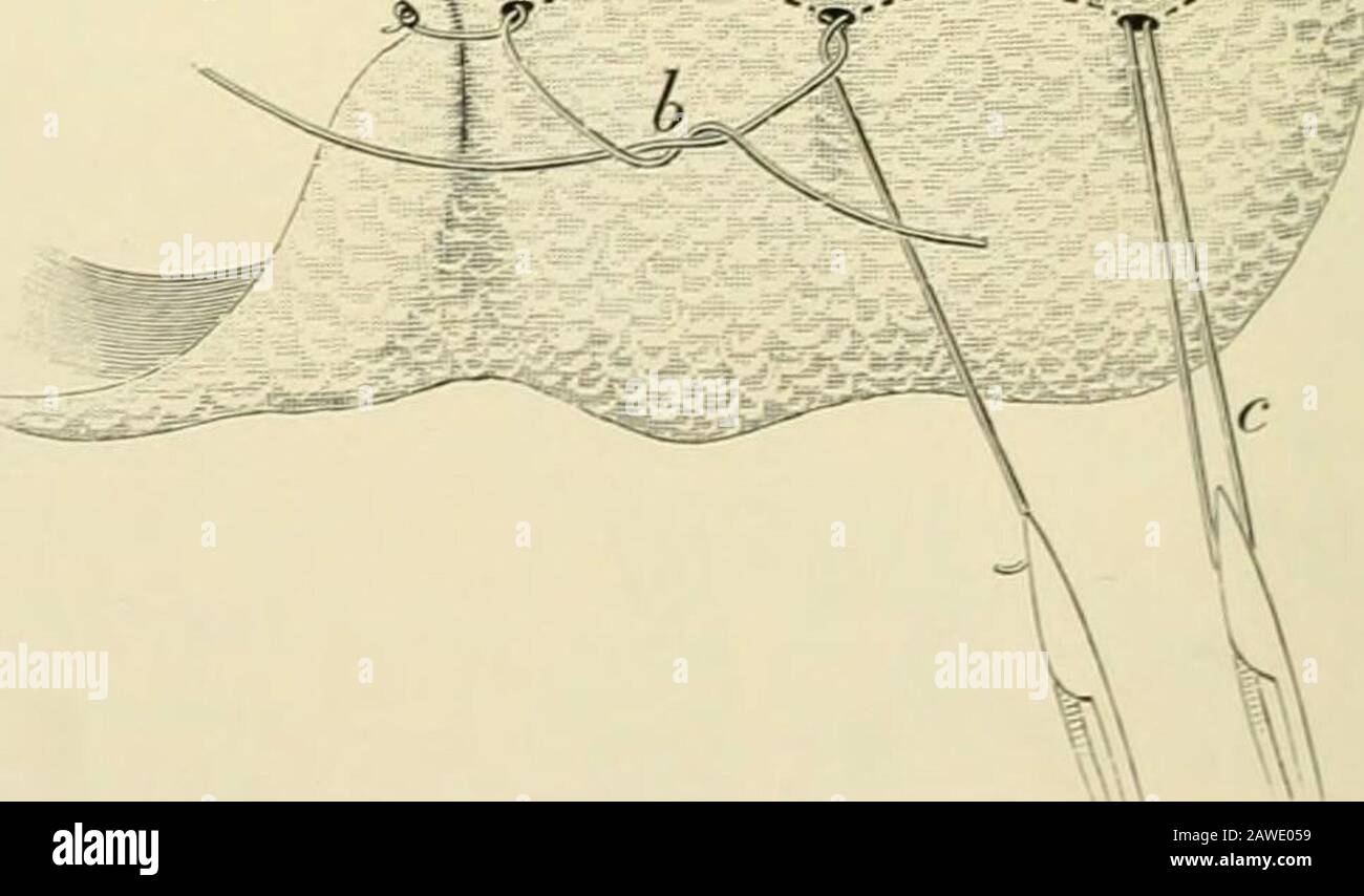 Chirurgia operativa . fter come bene prima del funzionamento. Sollevare il bacino o il piede del letto facilita l'urna. Lo smontaggio dell'apertura con ganci, afferrando i limiti del sacco con forcipressure e sollevandoli in una forma ad imbuto, ne aiutano l'urna. Altri manreuvres riparabili si verificheranno al chirurgo  M al momento. L'omentum -M^ viene solitamente rimosso ^ dopo la legatura in piccolo . - ,. Masse, e il moncone tornarono completamente nella cavità ab-dominale (Figg. LOlide 1110). La partenza dell'odomentum nel canale è discutibile, in quanto predis-pone a volvulus e con-tributi Foto Stock