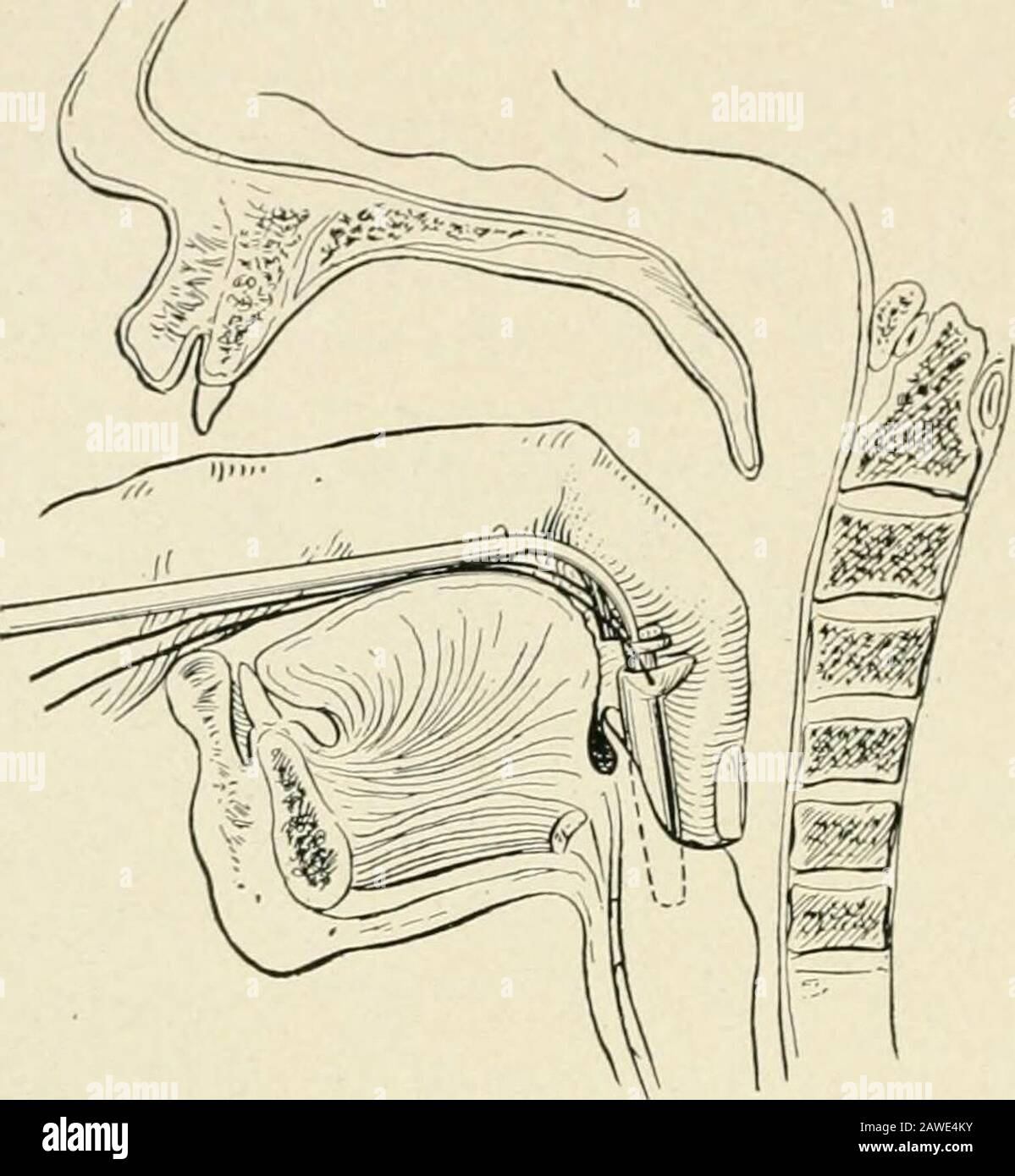 La pratica della chirurgia . trettch. Può essere impiegato un generico anesteticor cocain. La pelle viene incisa per due o tre mchesnella linea mediana, i muscoli e la fascia sono divisi, la tubazione a vento esposta da dissezione smussata, trascurando l'istmo tiroideo, thetrachea è catturato e steadiato con un gancio acuto e aperto spensierlycon un coltello con cautela, in modo da non avvolgere la parete posteriore delrachea. L'apertura tracheale viene quindi distesa con forcipe o dilatatore di valvola di atrio, e viene introdotta la cannula tracheotomica. I tubi per cohenstracheotomia sono quelli comunemente utilizzati. Il tubo completo (m-ner an Foto Stock