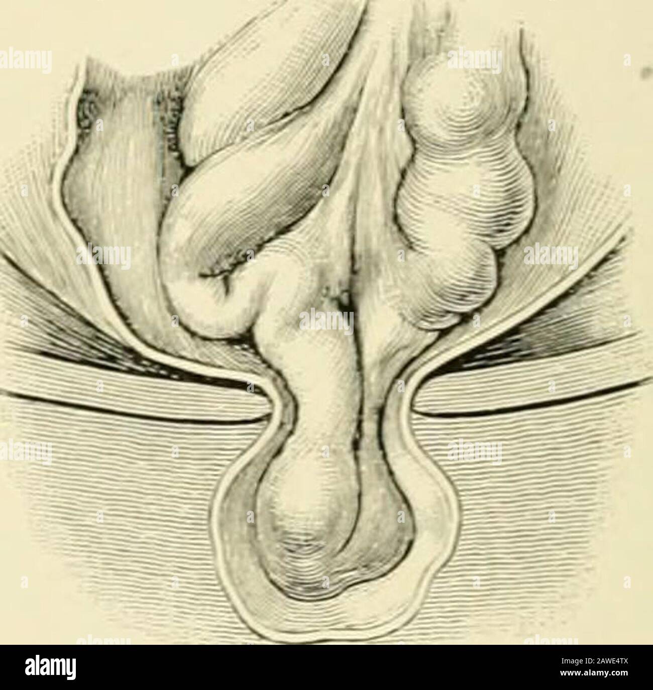 Chirurgia operativa . Fig. 1094. La sacca di ernia addominale. Fig. 1095.-una sacca, con contenuto intestinale di intestino tenue e di omentum (Fig. 1113). L'aspetto normale del theomentum e dell'intestino tenue dovrebbe essere dato uno studio attento, che il thesurgeon può essere in grado di determinare i vari gradi di cambiamento nella theirappearance quando sottoposto alle influenze differenti associate con l'ernialprominenza. L'aspetto granulare del grasso omentale, insieme al colore itspale e alla struttura extra fibrosa, lo distinguerà dal grasso subseroustissue. L'omentum e l'intestino, mentre nel sacco, al solito Foto Stock