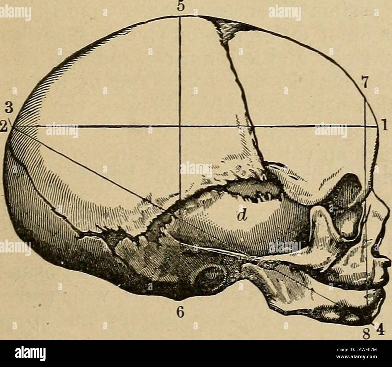ObstetricsManuale per studenti e professionisti . Mostra Fontanelles e su-tures alla Corona di testa;A,Ii, diametro biparietale. 1. I diametri longitudinali sono -Fig. 10. occipito-mentale, 5,4 pollici, dalla protuberanza occipitale al mento; occipito-frontale, 4,6pollici, dalla pro-tuberanza occipitale alla radice del naso; suboccipito - bregmatic, 3,8pollici, da metà tra la protuberanza occipitale e foramen magnum al centro della fontanelle anteriore. 2. I diametri verticali sono: il mento-bregmatic, 4,4pollici, dal mento al penetratore della fonta-nelle anteriore; il trachelo-b. Foto Stock