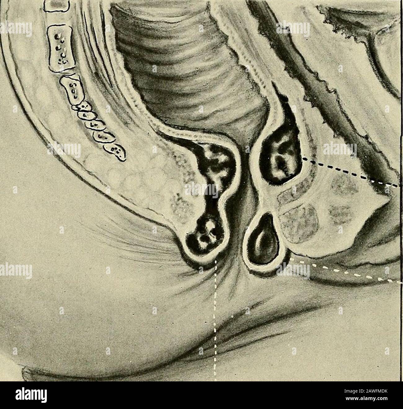 Gynecology . te.wrvr&lt;af.on. Imemcu..HemotrVunb ExternalMe.rvoYrlrvob Fig. Hemorrhoids. I tre tipi di hemorrhoids sono mostrati: Interno, esterno ed interno-esterno. Pennington.) (Dopo le cause dei pali sono straordinariamente numerose. Alcuni individui in-herit una predisposizione a mucchi in una deficienza congenita nel potere di sostegno dei loro tessuti. Molto importanti sono le condizioni che causano stasi o distruzione del sistema portale, in cui una lunga colonna di sangue è priva di valvole. L'utero in gravidanza e i tumori che esercitano pressione sui vasi mesen-terici o Foto Stock