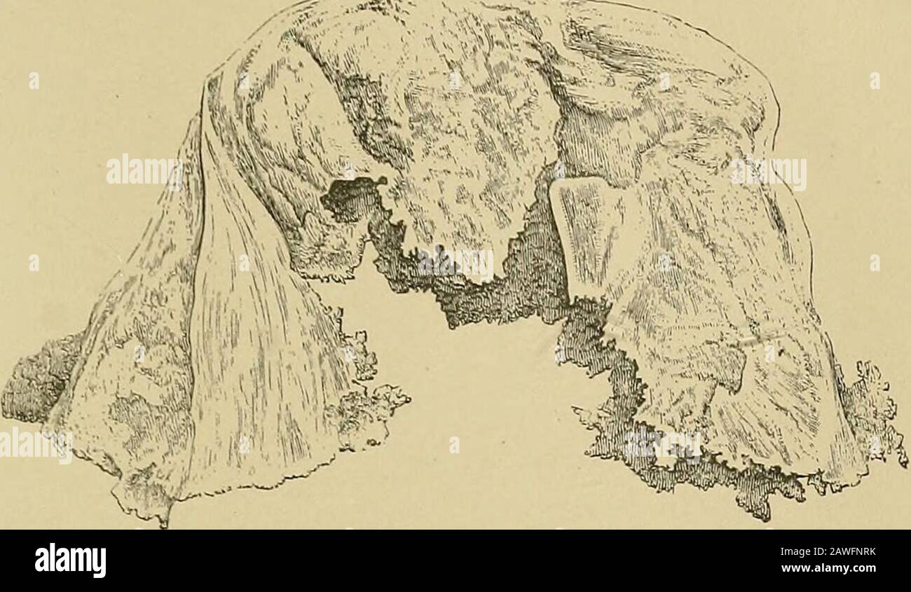 Malattie renali, depositi urinari e malattie calcolose : natura e trattamento . Fig. 64. fpu da cellule germinali-£ iil.-lial. X 215. Pag. 328. (A faccia pagina 32- URINARIO DEPCSLT3.Fig. 65.. Foto Stock