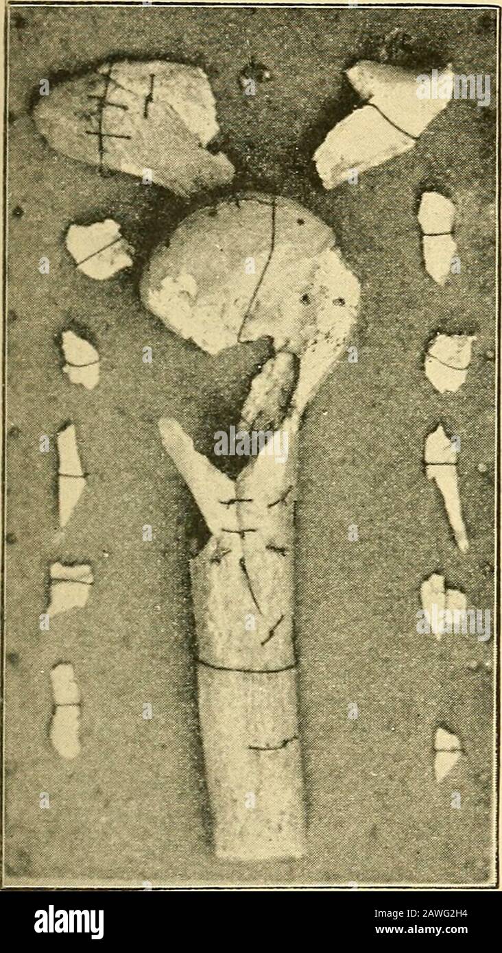 Ferite in guerra : il meccanismo della loro produzione e del loro trattamento . Fig. 38. Risultato di pallottola scollatura anatomica dell'omero. - Netley Museum. Ferite DELL'ARTICOLAZIONE DELLA SPALLA 147 la testa dell'omero è stata registrata anche da somesurgeons, tra gli altri da Chenu, come complicazione di una ferita da sparo della spalla. Trattamento.- nei casi in cui le ossa dell'arenot articolare implicato, ma la ferita capsulare semplice è certa fromla fuga della sinovia, o sospettata a causa della situazione delle ferite di entrata e di uscita, non è necessario fare alcun esame con strumenti o la suoneria. No oltre. Foto Stock