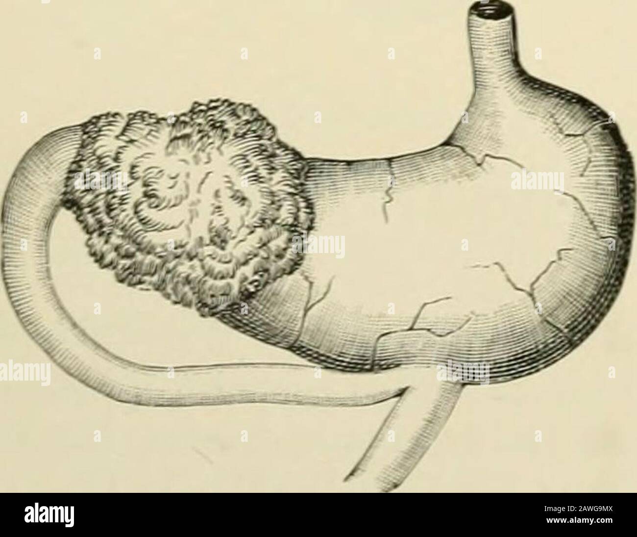Chirurgia operativa . astro-enterostomia. Nel primo, l'intestino tenue è passato davanti al colon trasversale e si è collegato alla superficie anteriore dello stomaco (Fig. 9Go, B); in quest'ultimo l'intestino viene trasportato attraverso il mesocolon trasversale o l'omentum astro-colico e unito alla superficie posteriore dello stomaco (Fig. 965, C). Un'obiezione al primo metodo (Fig. 9GG), per quanto più facile da raggiungere, è la più forte tendenza a rigurgitare il contenuto intestinale nello stomaco; a quest'ultimo, la maggiore difli-culità di unire le parti, e il maggiore pericolo di per Foto Stock