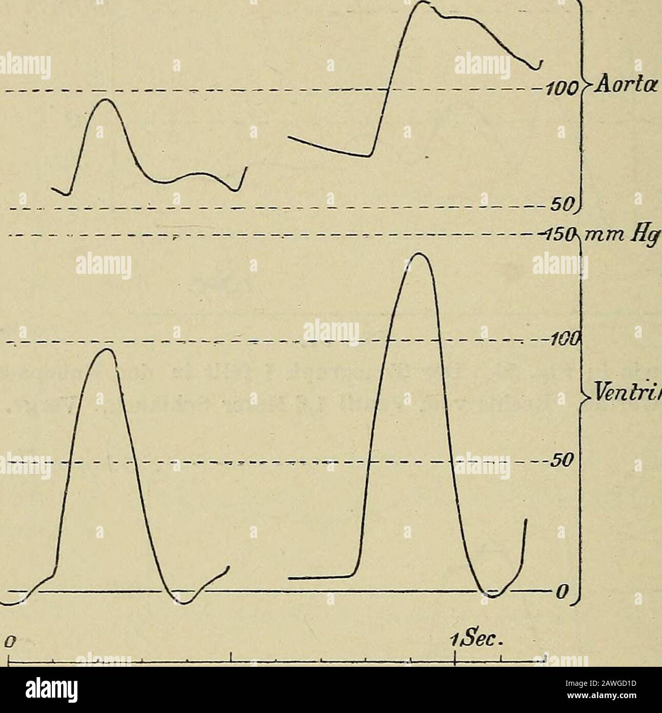 Die Untersuchung des Pulses und ihre Ergebnisse in gesunden und kranken Zuständen . J50 mm Hg ISEC Fig. 58.Derselbe Vertale wie in Fig. 57. Rechts Vom Ventil 4 Metri Schlauch. Die Eigen-schwingungen des Tonograpen i sind hier kleiner als in den Figg. 56 u. 57. Vergr. 1j/3 152 Der Arterienpuls und seine örtlichen Verschiedenheiten. Statt. Es müssen anche in der aorta Kräfte thätig ossein, welcheim Stande sind, den Klappenschluss schon herbeizuführen be-vor der Druck wieder auf den Ausgangspunkt zurückge-gangen ist. ALS eine der Ursacen, wheche hier wirksam werden, kannsofort die Reibung bezeichn Foto Stock