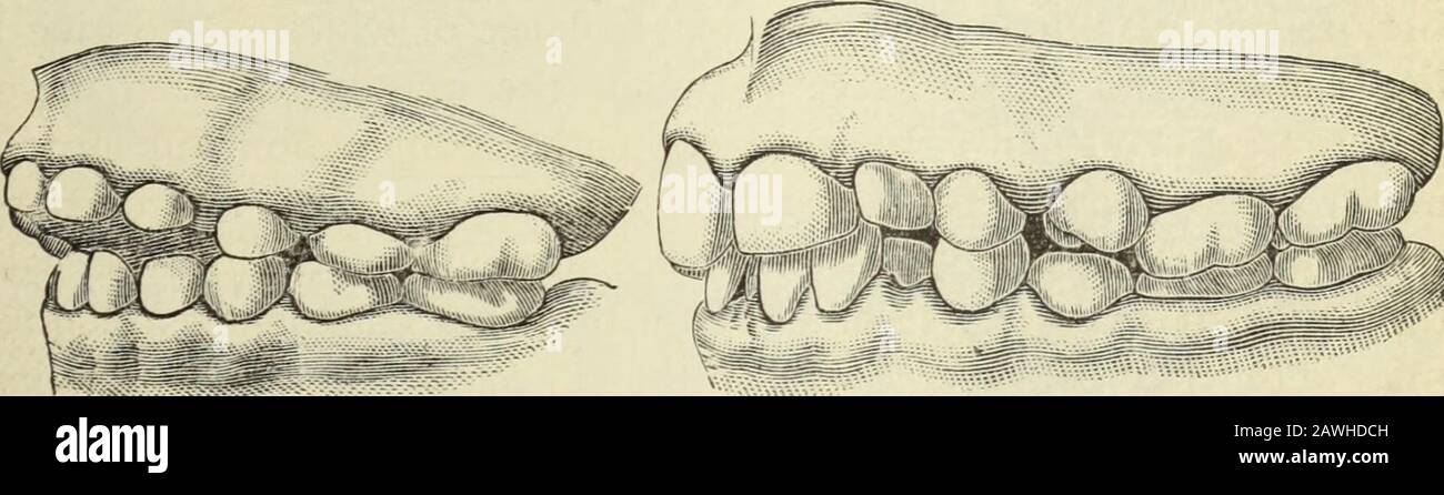 Il cosmo dentale . ere appare. Il successivo (Fig. 2) è il caso di un ragazzo di nove anni, che suckedhutch pollice fino a quando era di quattro anni. È possibile vedere che vi è una proiezione con-siderabile degli incisivi. Il caso successivo (Fig. 3) è quella di età di quattordici anni, con notevole proiezione della mandibola superiore e accorciamento della mandibola inferiore. Lei ha succhiato il pollice fino a che lo shewas quattro anni. Il caso successivo (Fig. 4) è quella di una ragazza di sedici anni, con una grande proiezione degli incisivi superiori e accorciamento e appiattimento della mascella inferiore. Ha succhiato il pollice fino a che non wassix anno Foto Stock