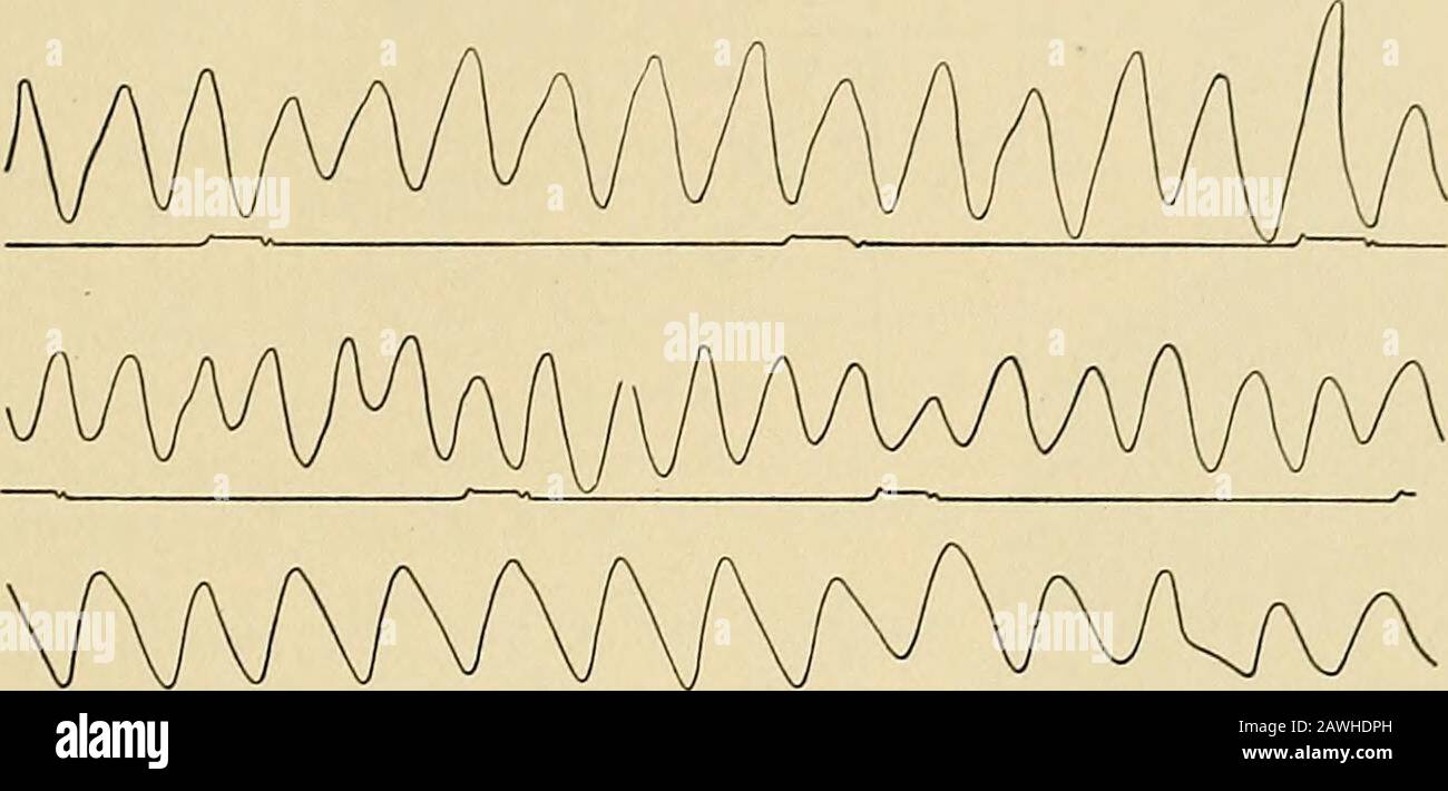 Un sistema di medicina pratica . Tremore di paralisi agitano: Lenta rivoluzione del tamburo ; singolare raggruppamento di serie di onde, eacli quattro secondi. Secondi. Sembrava che i ritmi innervati fossero tonificatesissimi secondi; Questo non sembrava essere correlato a quello cardiaco o alla respira - Fig. 68. Tremore di paralisi agitans : rivoluzione più rapida del tamburo. SINTOMI. 677 influenza canonica, e può essere stato dovuto a qualche fattore sconosciuto (tale ritmo asnutrizionale nelle cellule corticali (?)). Con una più rapida rivoluzione del tamburo si ingrandiscono le onde, come nella serie di quattro tracciati dal polso illustratore Foto Stock