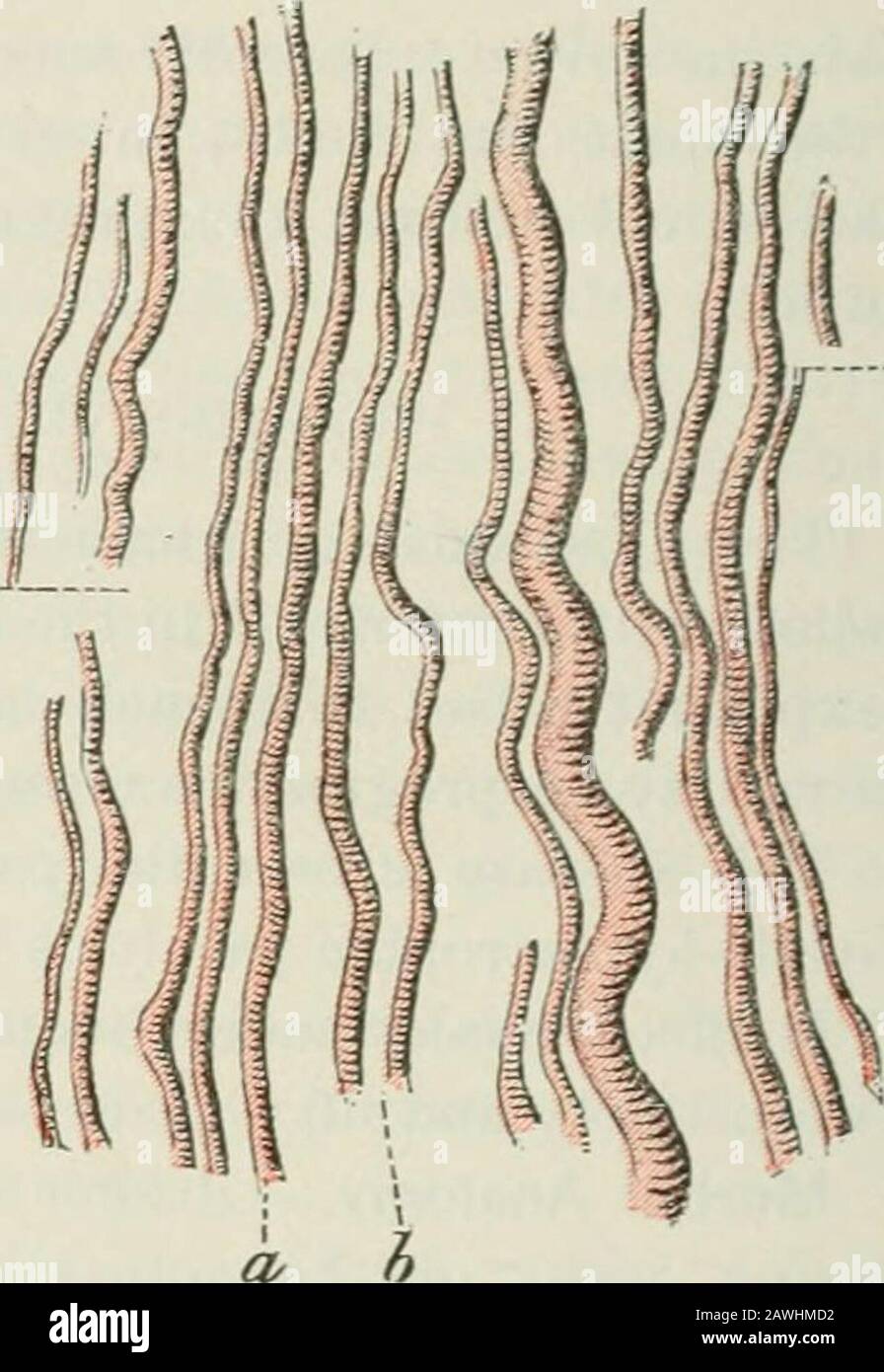 Conferenze sulle malattie nervose dal punto di vista della localizzazione cerebrale e spinale, e i metodi successivi impiegati nella diagnosi e nel trattamento di queste affezioni . fe .J .:F. Fig. 104.- Le Fibre puntano il Diaphrag.m in Fig. 105.-Stesso preso un caso di Pro-Health. (Charcot.) Atrofia Muscolare gressiva che colpisce Il Diaframma. (Charcot.) le fibre di muscolo (a) sono grandemente atrofizzate ma preservano la loro striatura trasversale. Gli intervalli del tessuto connettivo (b) sono maggiorati; (2) sforzi muscolari eccessivi; (3) lesioni traumatiche delle parti periferiche del corpo; (4) avvelenamento da piombo; (5) certa Foto Stock