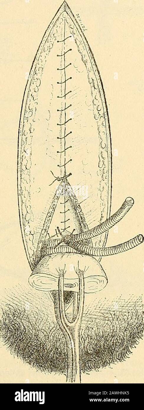 Traité de gynécoologie clinique et opératoire . (,c£?&gt;n. Fig. 51. Sutura des parois abdominales après lhystérectoraie. Premier étagede la sutura conlinue (péritoine). Fig. 52. Continua La Seconda étage de la suture (planimetria musculo-aponévrotique). Pris entre deux sutures profondes. CES points sont placés le plusprès possible de la tranche des téguments et doivent assurer leurcoaplation acte. (JE les remplace souvent par une suture continueau catgut.) Ce nest que lorsquils sont entièremremement placés et nouésquon serre et quon noue les points de sutura profonde, après avoirenlevé les pinces qui en Foto Stock