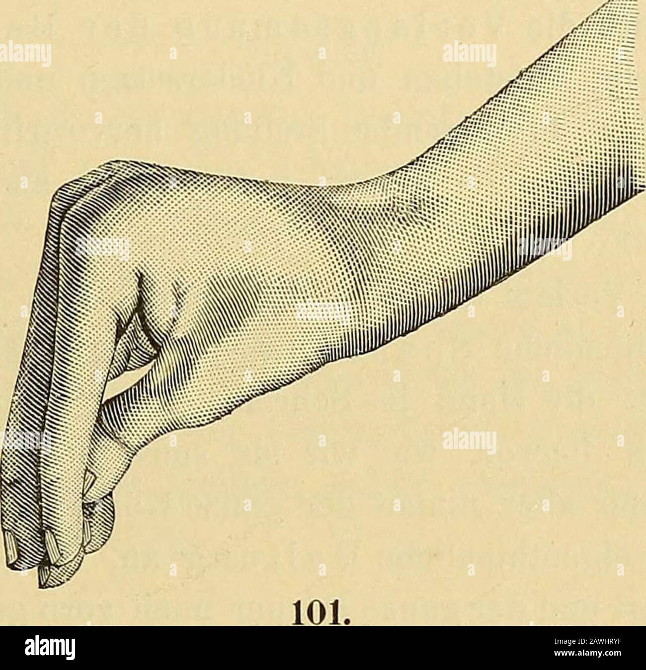 Lehrbuch der Krankheiten des Rückenmarks und Gehirns sowie der allgemeinen Neurosen : für Aerzte und Studiende . deren Geschlechts ist nichtsicher erwiesen. Die Krankheit ist eine relativ seltene; die Angabenüber eine besondere Häufigkeit derselben in Inghilterra und Nordamerikadürften auf Irrthum in der Diagnose zurückzuführen ein. Paralisi agitans. 675 Symptome-Das Zittern befällt gewöhnlich zuerst die rechte Oberextremität,von hier greift es auf die rechte Unterextremität über und noch späterkommt der linke Arm und schliesslich das linke Bein an die Reihe.Zunächst zeigt es sich an der Hand i Foto Stock