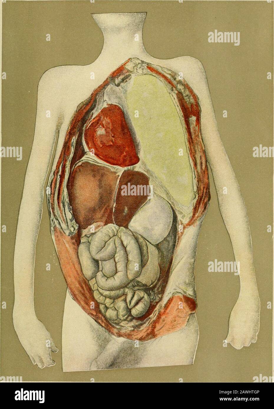 Medicina moderna : la sua teoria e pratica, nei contributi originali degli autori americani e stranieri . PyopPneumothorax - PIASTRA Laterale Destra VI. PyopPneumothorax - PNEUMOTORACE sinistro 875 fatto che in salute la sua forma è mantenuta in parte dalla forza contrattile del polmone. Quando l'aria viene immessa nella pleura questa forza diventa inoperativaper quanto riguarda il diaframma, e quest'ultimo poi affonda. Se c'è solo aria, ci vuole approssimativamente una posizione orizzontale. Se è presente una quantità considerabiledi siero o pus, è forzata verso il basso dal peso pure dal tiro del vis addominale Foto Stock