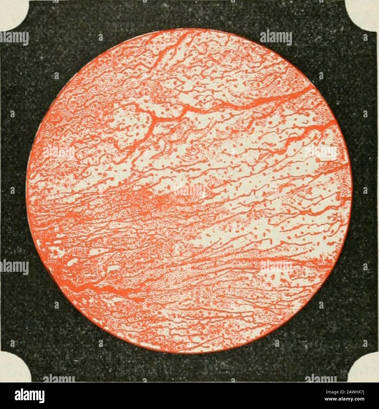 Conferenze sulle malattie nervose dal punto di vista della localizzazione cerebrale e spinale, e i metodi successivi impiegati nella diagnosi e nel trattamento di queste affezioni diventano estremamente difficili. Uno dei miei pazienti richiede l'aiuto di un servo del corpo per quella ragione da solo. Infine, i tracciati dinamografici 332 LEZIONI SULLE MALATTIE NERVOlS, mostreranno un'incapacità di mantenere la contrazione della coiitiniiotite dei themnsclos. Quando le gambe di tlie vengono attaccate, la rait <somiglia strettamente al thatof paralisi agitans (pagina 163). Il ginocchio e il piede sono atti a moveinvolontariamente quando il paziente è seduto o reclinato Foto Stock