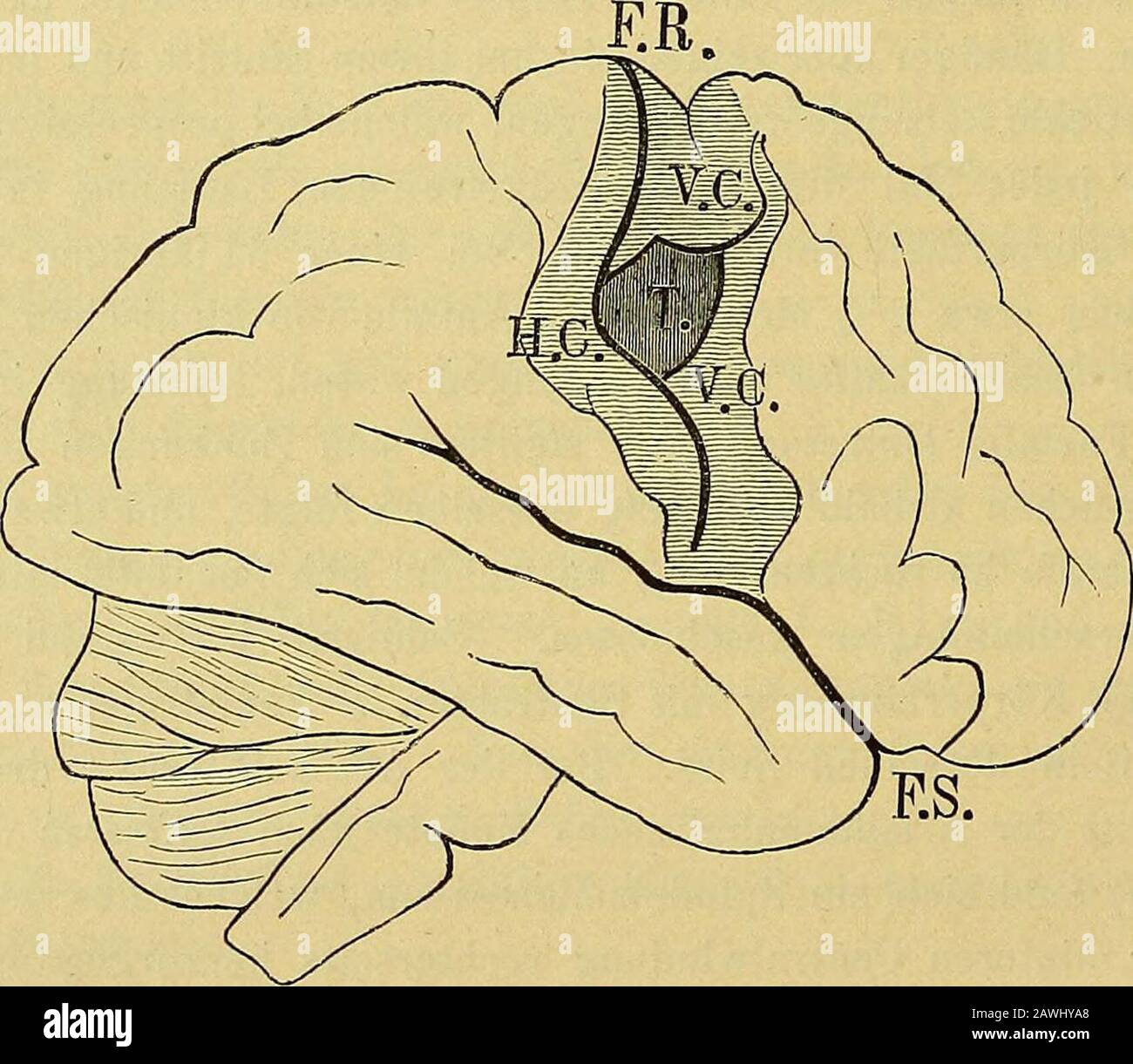 Lehrbuch der Krankheiten des Rückenmarks und Gehirns sowie der allgemeinen Neurosen : für Aerzte und Studiende . e, vier Jahre alt, hatte vor18 Monaten einen Drüsenabscess an der fechten Halseite, der sichnichnicht nichnach aussen öffnete, gehabt und zeigte seit 12 Monaten Links Stra- Rückenmarksla, Seeligmüll und Geehiten-  . 23 354 Allgemeine sintomatologie der Gehirnkrankheiten. Bismus internus. Am 21.mai 1878 klagte sie über Parese des linken Arms;am 23. Und seitdem noch drei Mal hatte sie Anfälle von Zucken imlinken Arm mit Augenverdrehen, welche 10-25 Minuten lang anhielten.Am 29, Foto Stock