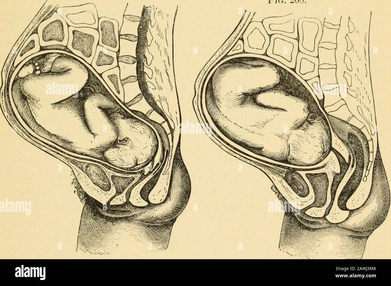 Un sistema di ostetricia . heregion dell'ombelico misura 95 cm., a metà strada tra la naveland la sinfisi, 97 cm.; la distanza media tra il processo di ensiformizzazione e il pube è 43J cm. Le pareti addominali sono tese in 1 Ann. D. I. Soc. Med. Disco, de LQge, 1S80. LA DIAGNOSI DI GRAVIDANZA. 385 la primipara, e l'anello ombelicale è leggermente convesso. La porzione non vaginale nel priniparse viene ammorbidita, e la testa si sente sopra l'ingresso appena in procinto di impegnarsi. Alla fine del nono mese il fondo ha raggiunto la sua elevazione, vicino al processo di ensiform. La circonferenza media Foto Stock