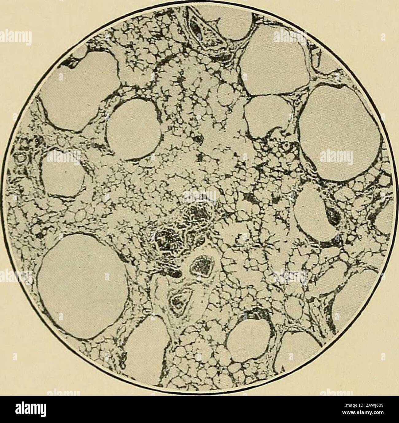 Medicina moderna : la sua teoria e pratica, nei contributi originali degli autori americani e stranieri della strutura bron-chial. Patogenesi. - C'è molta differenza di opinionas al modo di produzione della dilatazione bronchiale, ma tutti sono agreedthat l'affetto è un secondario. È generalmente preceduto dalla cronicopatia del bronco dilatato, e associata a questo vi è, di norma, la sclerosi del polmone e la pleura. I vari pareri sul meccanismo di dilatazione possono essere groudedinto due classi: 1. Quelli che considerano le cause che agiscono all'interno dei bronchi come playingThe pr Foto Stock