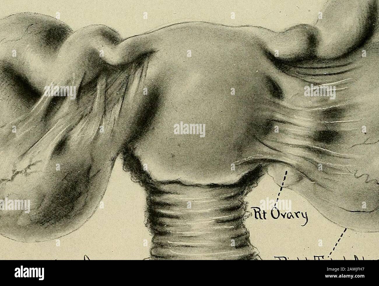 Ginecologia Wvoaeo Hnb Fig 36 Tubo Ovarite Diagramma Che Mostra Come Un Tubo Infiammato Puo Essere Attaccato All Ovaio E Comunicare La Sua Infezione All Ovaio Attraverso L Apertura Di Un Corpo Luteo Xe T Tu O Ouoxuva