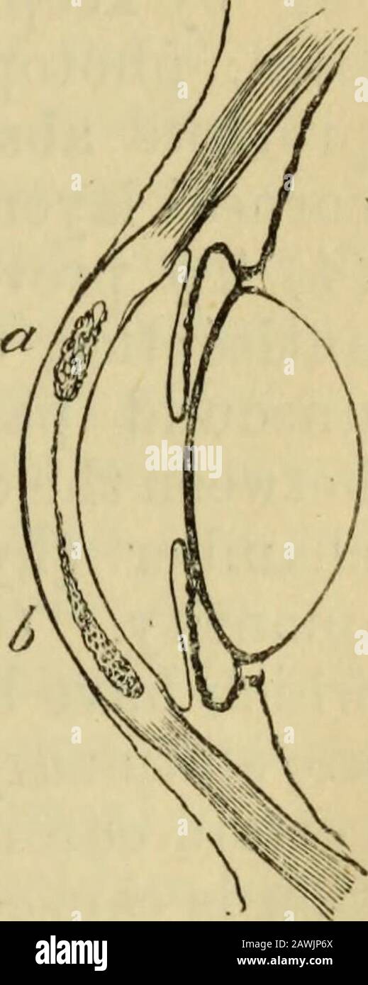 La guida dello studente alle malattie dell'occhio . Il bottitself è generalmente piccolo andcirconciso; esso usuallyscoppia in avanti, ed è convertito in un'ulcera, ma itpuò perforare la posteriorsurface della cornea. C'è sempre una certa nocività dell'intera cornea, e l'infiltrazione tepurulenta può, ifthe caso fare male, spargersi e coinvolgere quasi il suo intero ex-tenda. Hypopyon significa una raccolta di pus o di puro-linfa nella parte più bassa della camera anteriore; il suo limite superiore di solito, ma non sempre, livello (Fig.43). Può verificarsi con qualsiasi acuteulcera, profonda o meno, che è accompagnata da Foto Stock