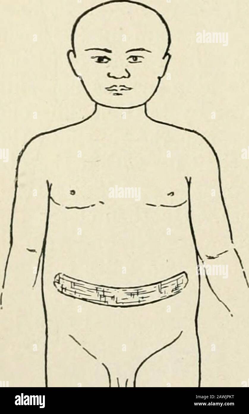 La pratica di chirurgia. Del primo e il rilassamento dei loro muscoli ab-dominali, e specialmente dalla distensione ab-dominale dovuto gravidanza e grandi tumori pelvici. L'ernia cresce abbastanza rapidamente. Comunemente, itcontains l'omentum e l'intestino tenue, ma può contenere l'omentum, l'intestino largeario e, raramente, lo stomaco o persino gli utemi. Le coperture di questi hernise sono sottili e sono composte da poco oltre la pelle e fascia superficiale, in modo che il sacco erniale, sporgente tra i reticicli attraverso l'anello ombelicale, sia vicino alla pelle e spesso aderente ad essa. Questi hernise sono Foto Stock