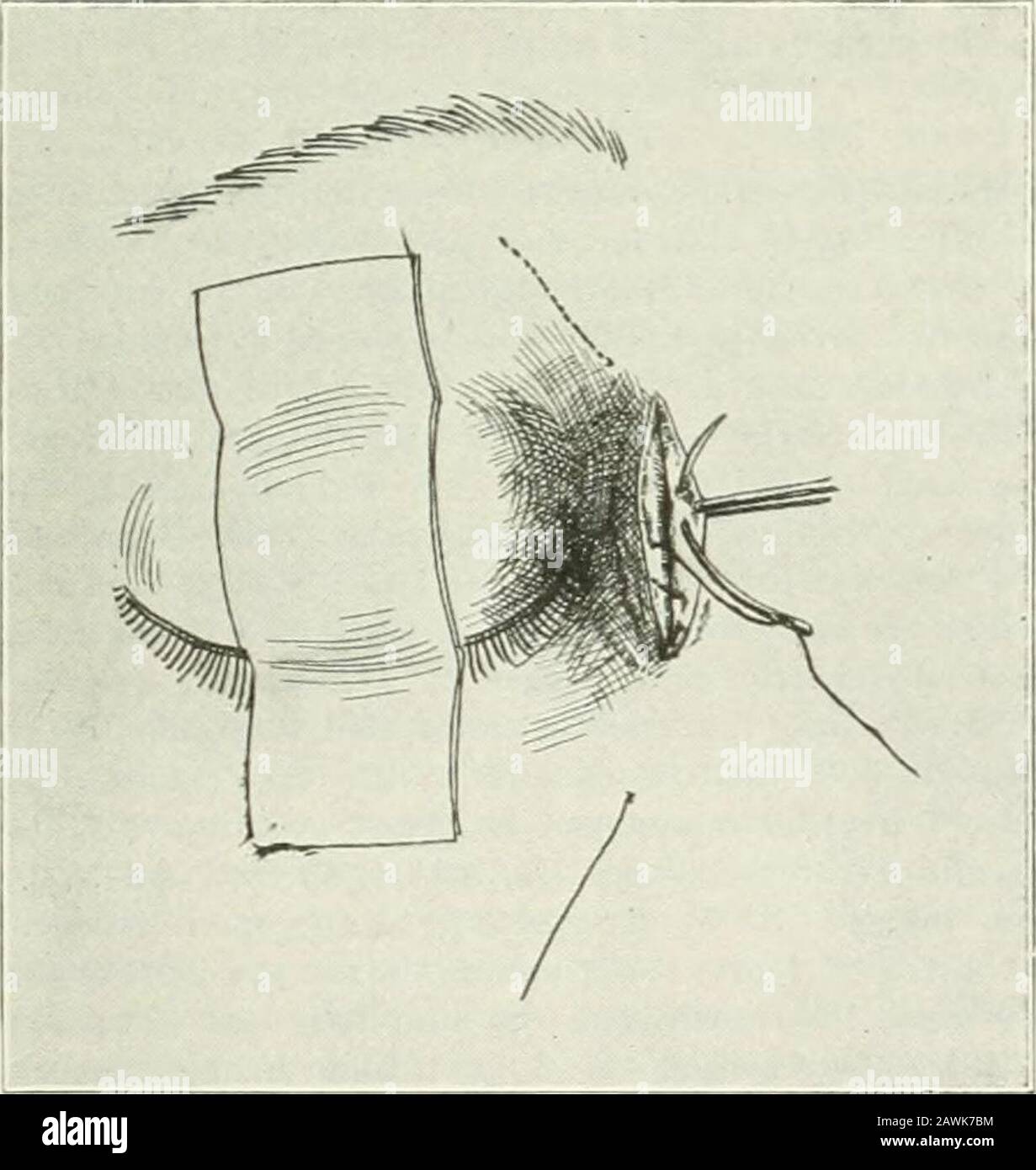Transazioni . Fig. 9. Fig. 10 154 non sempre necessario e nei pazienti che vengono sottoposti ad anestesia underlocal è atto ad essere piuttosto doloroso, anche se questo può essere superato belargamente oscillando prima con adrenalina e cocain. L'incisione della pelle può essere chiusa mediante sutura interrotta, O asis mostrato nel taglio allegato (taglio n. 10), mediante sutura continua sottocutanea. L'autore è convinto che si ottenga una più cicatrizzazione se, in questa fase, si passa una sutura attorno ai tecaliculi sia nel coperchio superiore che nel coperchio inferiore, proprio sul lato nasale della puncta. Questa sutura può essere legata con un kno abbastanza stretto Foto Stock